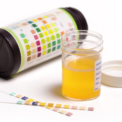 marcadores-encontrados-na-urina-podem-ajudar-no-diagnostico-do-autismo