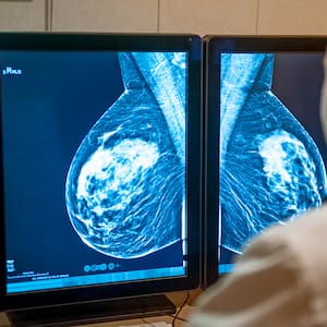 breast-cancer-screening-age-extension-welcomed-by-waikato-surgeon