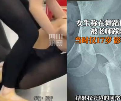 重慶17歲女學生學跳舞遭老師踩斷腿終身無法再跳-怒告涉事機構