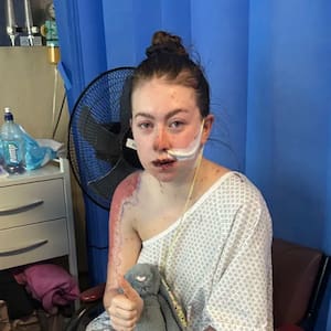 palmerston-north-woman-hospitalised-for-a-month-with-stevens-johnson-syndrome-after-reaction-to-medication
